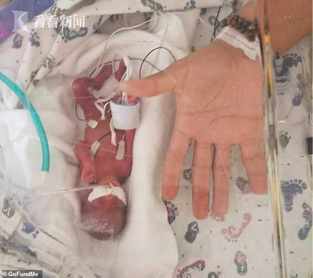 手掌婴儿23周出生重不到1斤被判死刑顽强存活