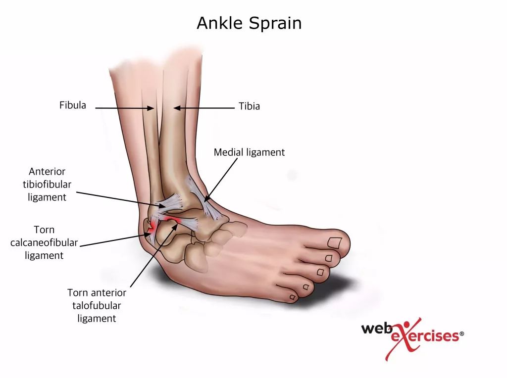 下肢康复系列:脚踝扭伤