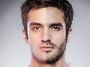 冰点脱毛能彻底去掉男性的络腮胡吗？