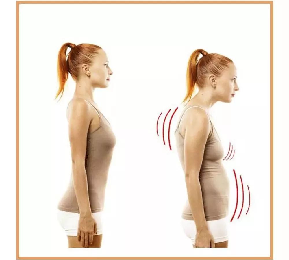 侧腰粗壮主要是驼背等 不良体态挤压导致的