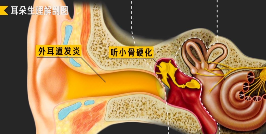 当外耳出现外耳道发炎变窄,或中耳有听小骨硬化等疾病,就会影响声音的