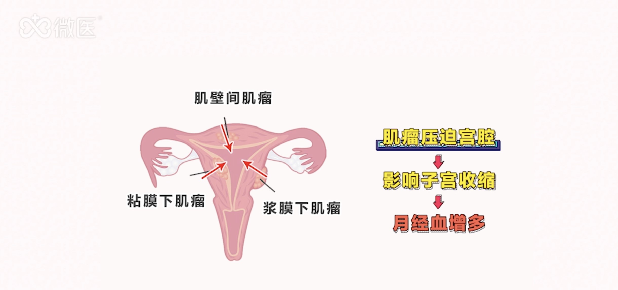 子宫内膜容受性检测(ERT)