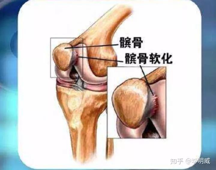 拍片子显示髌骨软化了,应该如何康复好?