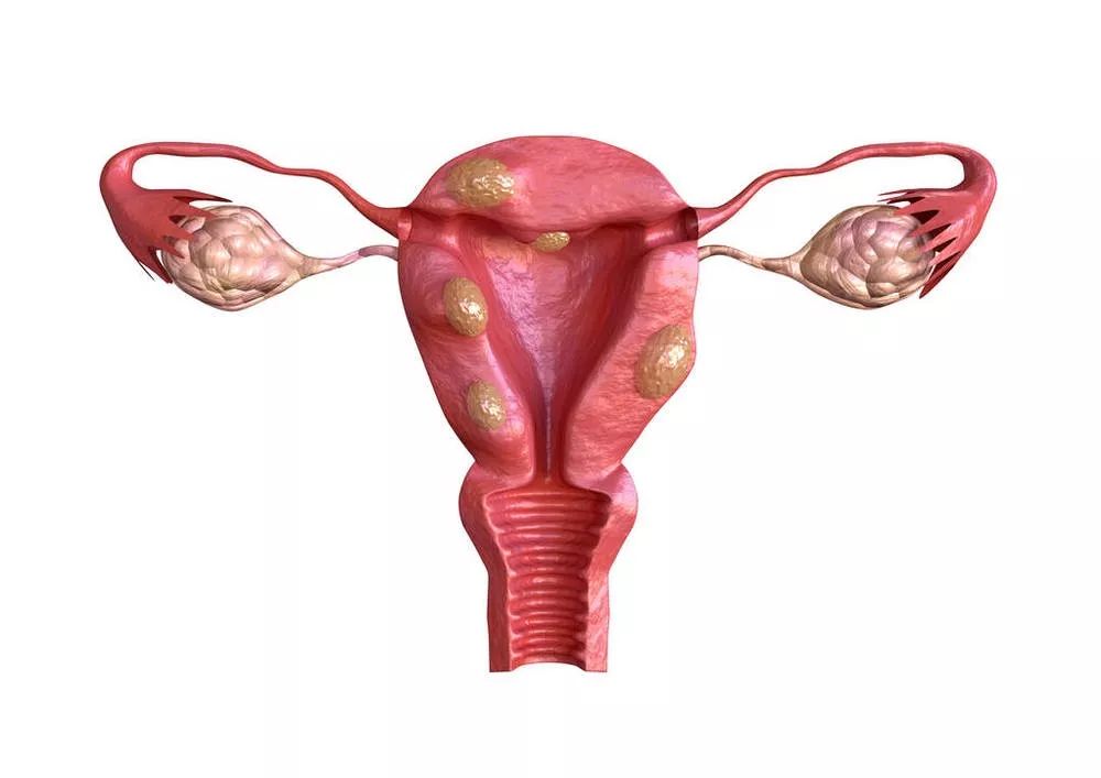 子宫后壁,可压迫直肠引发下腹坠胀不适,便秘;发生于阔韧带里的肌瘤可