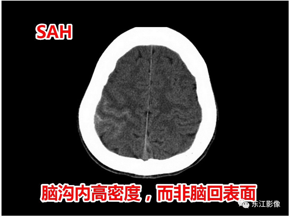 sdh? 脑沟脑裂脑池出血,是蛛网膜下腔出血的可靠征象.