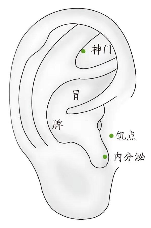 在耳朵上压豆,简单有效的减肥方