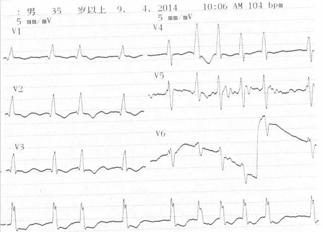 心电图来鉴别(4)——右心衰合并呼吸衰竭