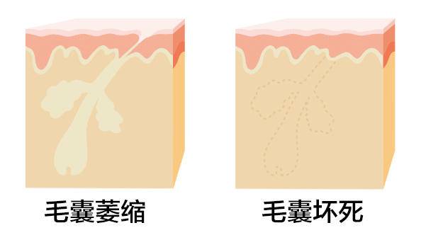 毛囊闭合真会长不出头发?