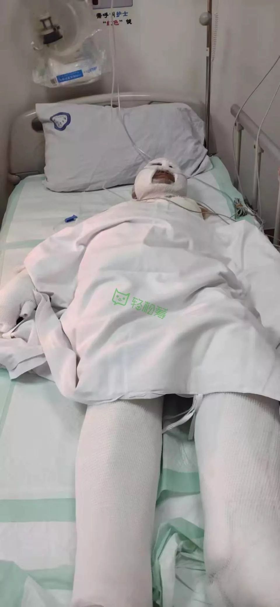 房屋突然爆炸,14岁男孩全身严重烧伤!只因一个不经意动作