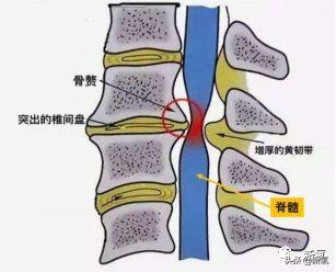 一般是由于椎间盘突出,骨质增生以及颈椎管变窄而对脊髓产生了挤压.