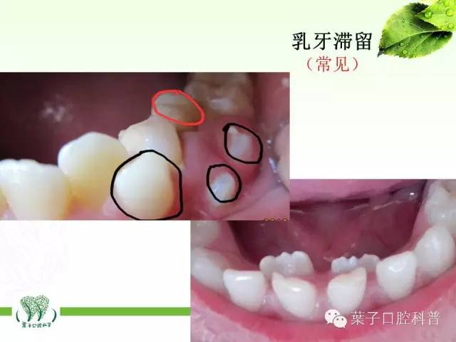 1. 乳牙滞留 孩子恒牙长出来了,但是乳牙还不掉怎么办?