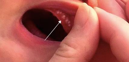 小宝宝嘴巴里的"小白点",是长牙了吗?