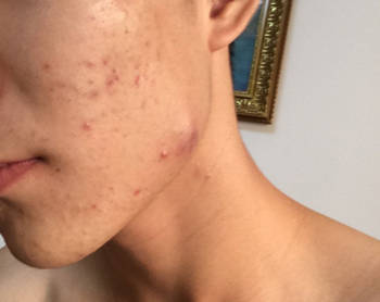 脸上长大疙瘩里面硬的