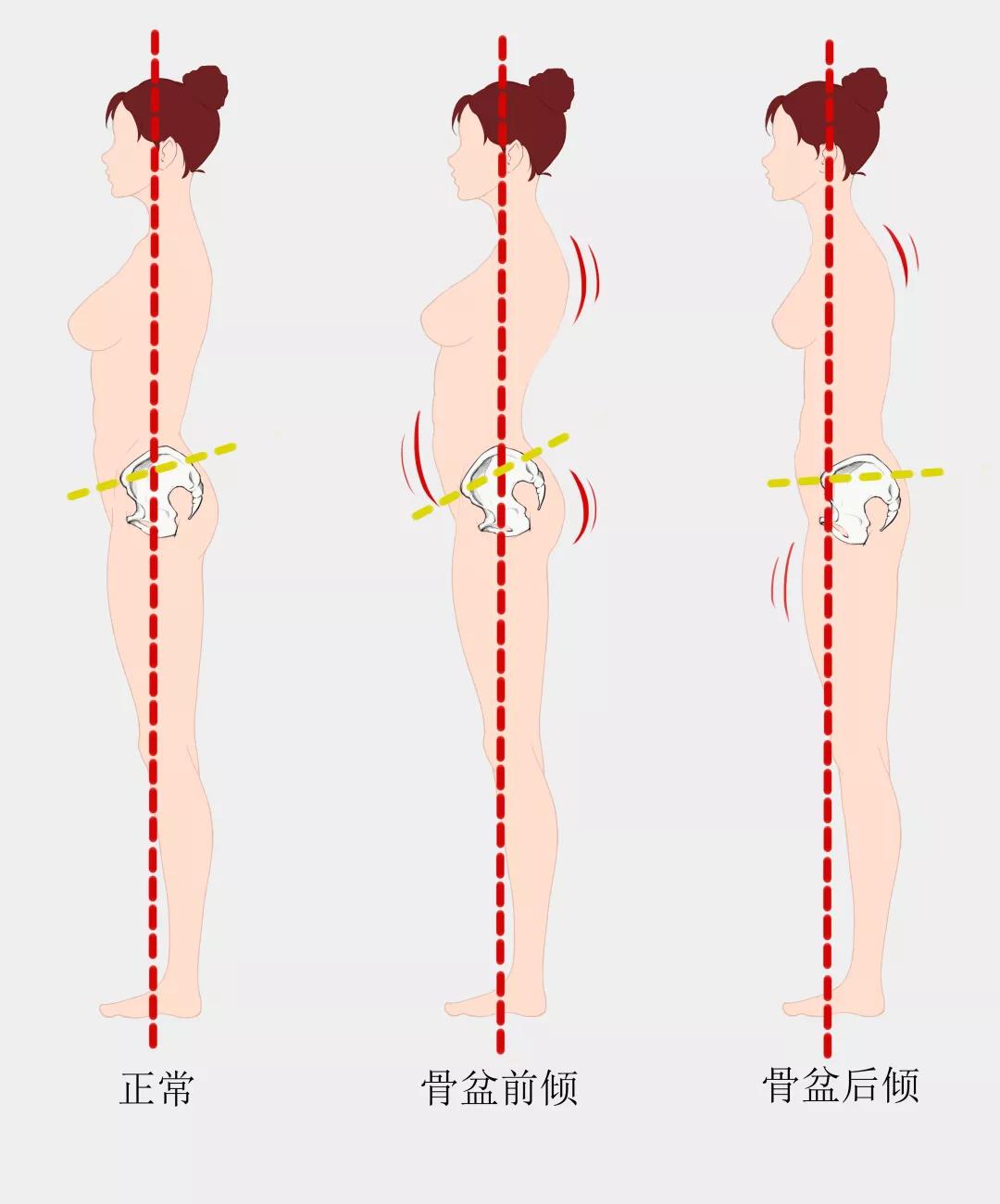 体态矫正——6个动作帮你告别难看的骨盆后倾!