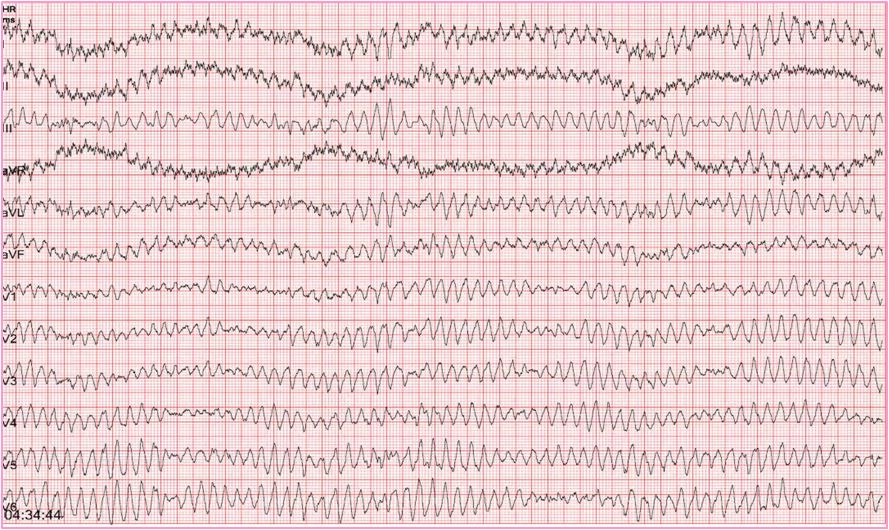 室颤心电图: 大小不等,极不匀齐的快频率波,频率达200~500次/分. 4.
