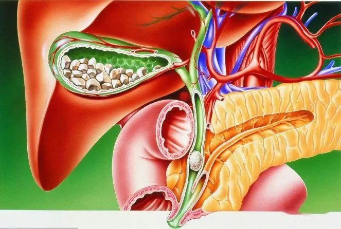 胆囊结石的临床症状表现是什么?