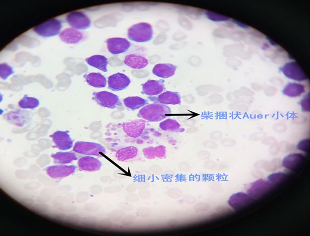 早幼粒细胞内柴捆状auer小体和细小密集的异常颗粒