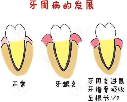 4,青少年牙周炎:这种病发病比较快,一般在早期就会出现牙齿松动的