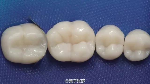 去除成型片,去除成型片楔子.