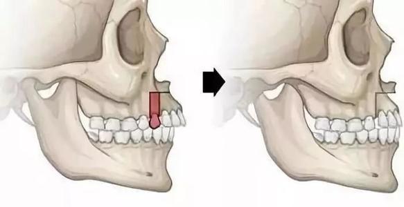 牙性的区别在于是「骨」还是「牙」,上颌骨发育过度的突即为骨性前突