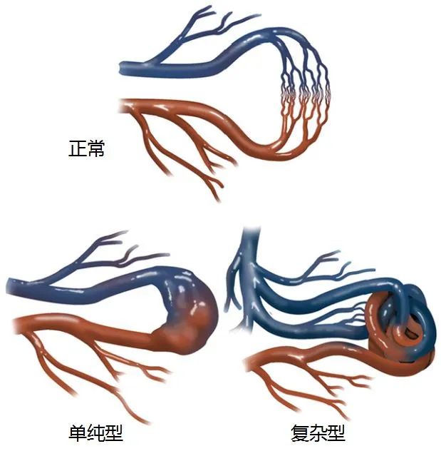 心动在线丨一则典型的肺动静脉瘘