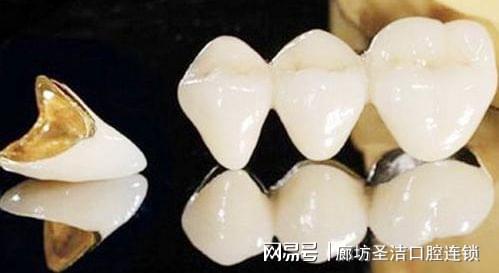 半贵金属:半贵金属烤瓷牙的代表是钴铬合金烤瓷牙,称之为"无镍无铍