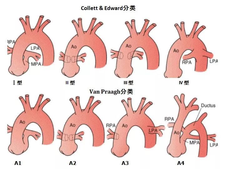 图16. 永存动脉干分类示意图.