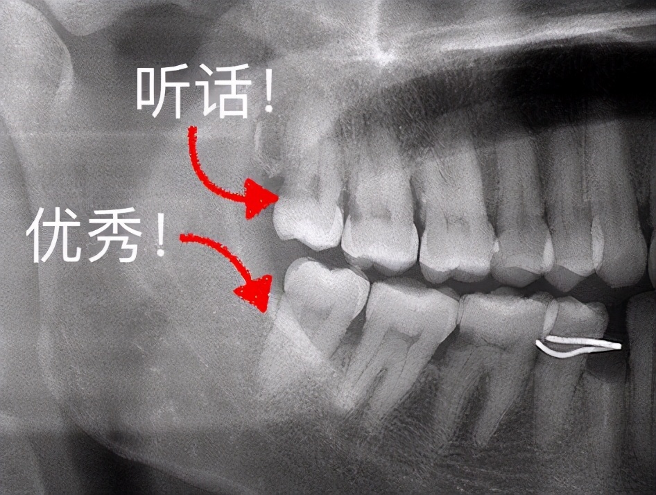 但也不能认为智齿萌出后不痛不痒就不需要拔,因为如果智齿位置长的不