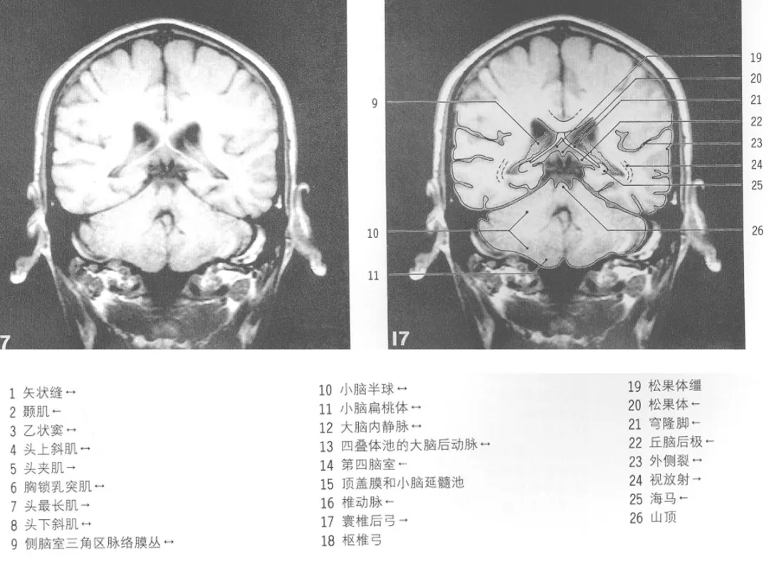 影像基础:mri颅脑冠状位解剖图谱