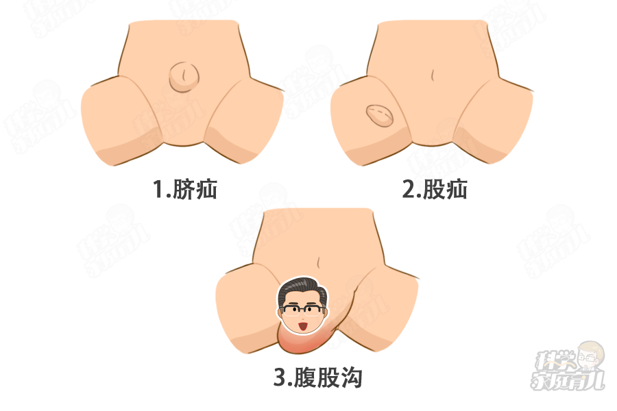 图片来源:科学家庭育儿原创 常见的疝气有脐疝,股疝和腹股沟疝.
