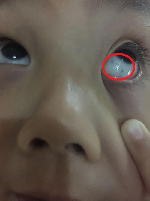 孩子眼白有"黑点"是长虫?家长别着急,多半是这2原因导致的