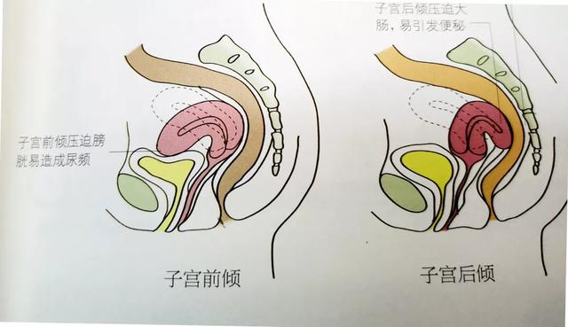 如果 子宫前倾压迫膀胱,易 造成尿频;子宫后倾压迫大肠,易 引发便秘.