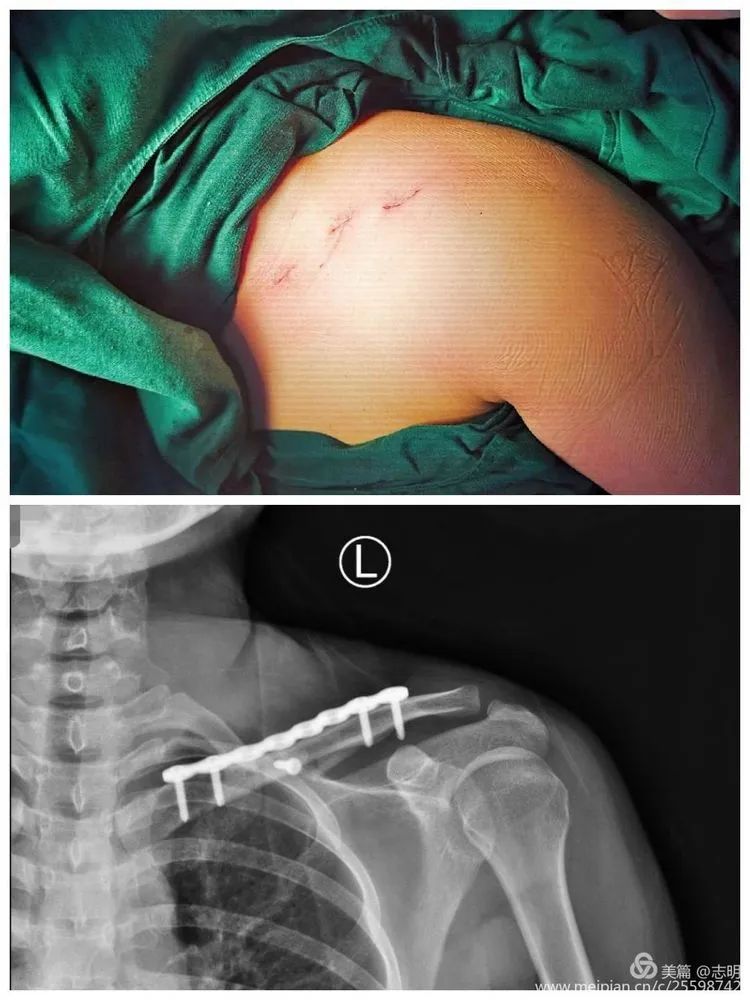 技术要点:锁骨骨折微创治疗之mipo