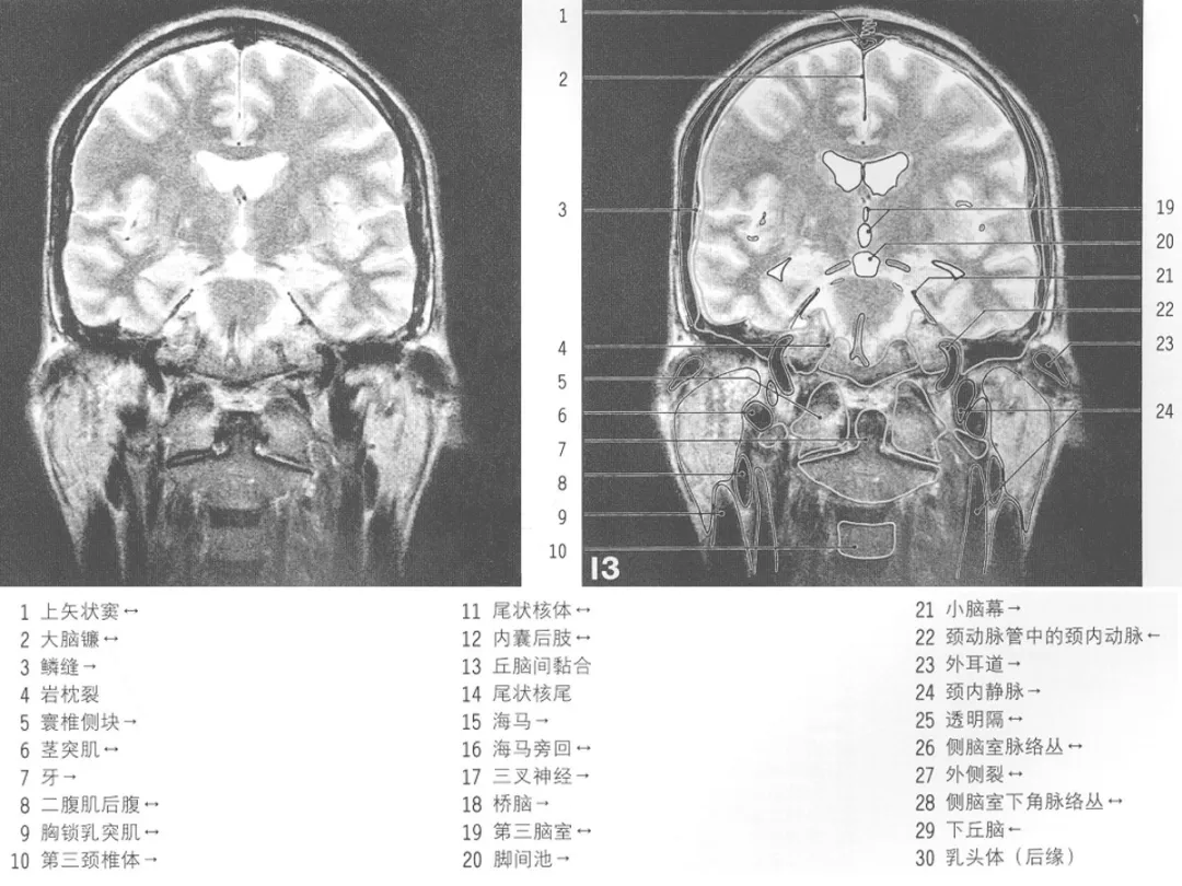 影像基础mri颅脑冠状位解剖图谱