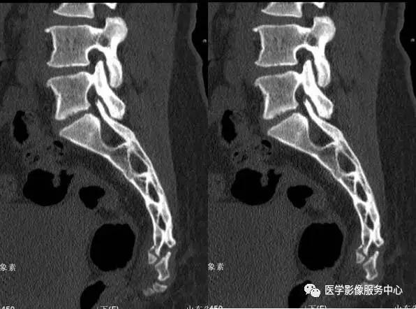 另外,骶尾骨骨折,特别是尾椎脱位的诊断还要和临床紧密结合.