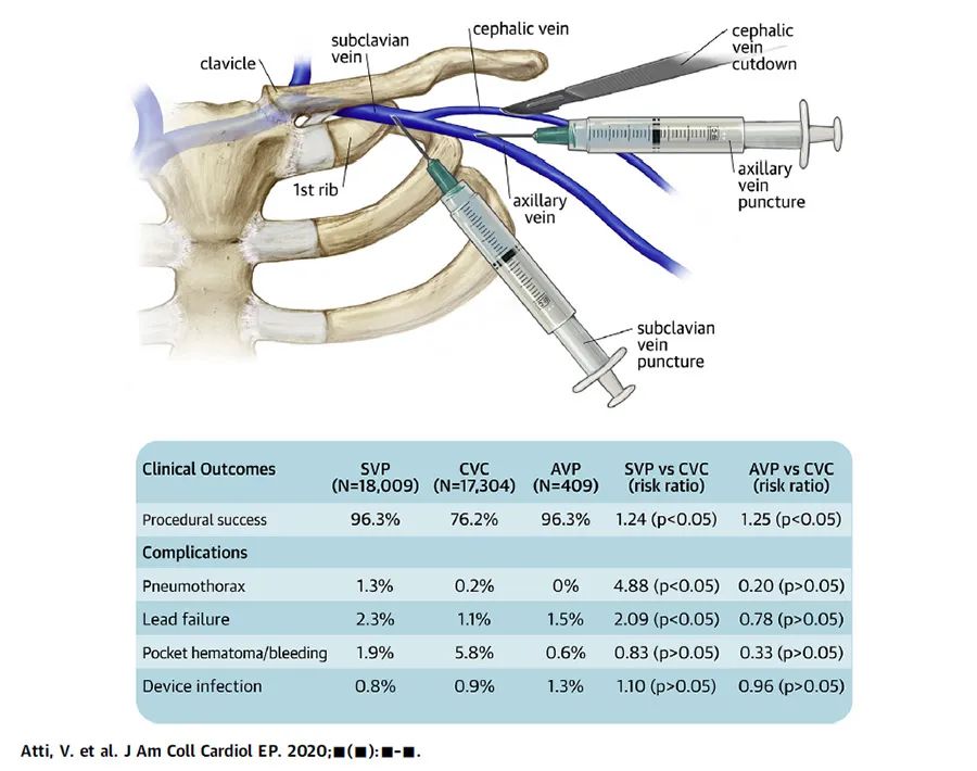 acc2020丨锁骨下静脉腋静脉穿刺和头静脉切开术哪种入路更安全有效