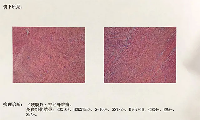 面麻疼痛:到底是三叉神经痛还是脂肪瘤造成?元凶竟是脑深处