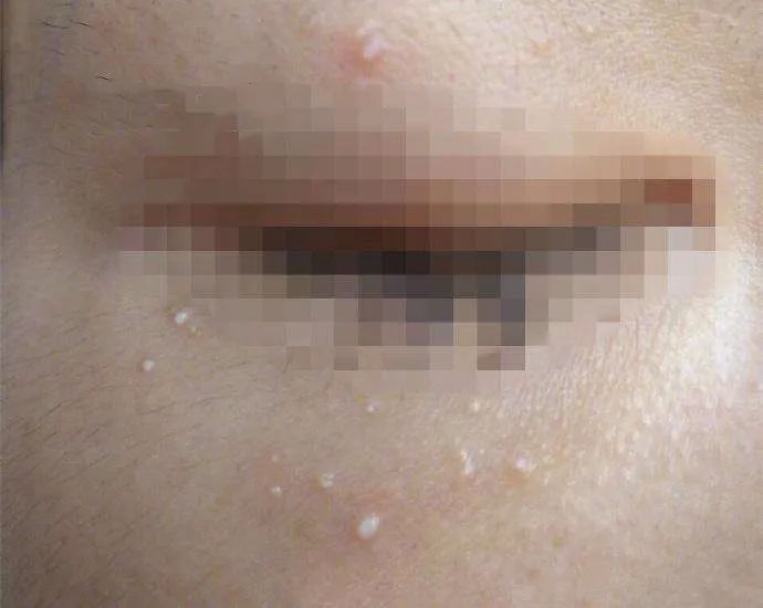 眼周脂肪粒,大多是看起来很像痘痘,但又不痛不痒不发炎的 粟丘疹.