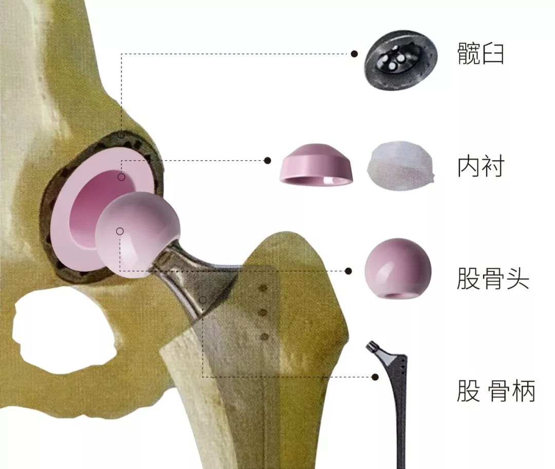 膝关节置换术复杂吗?-健康百科