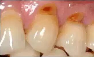 当牙周炎发展到中晚期,牙槽骨吸收,导致牙龈萎缩,牙根面外露,而失去