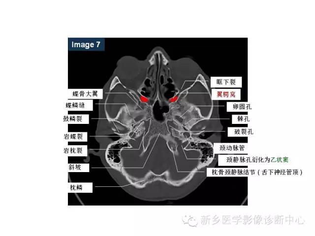 鼻咽部的详细解剖