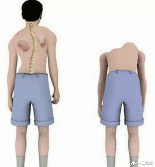 儿童脊柱侧弯有多严重?