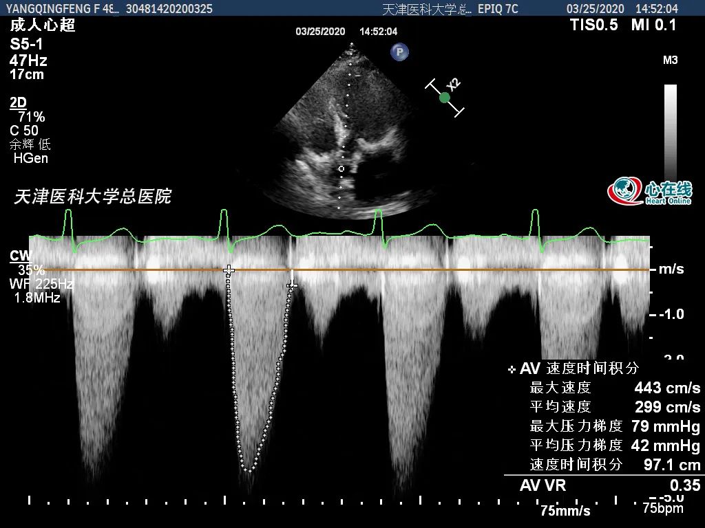 综上所见,此次超声发现人工主动脉瓣和二尖瓣流速显著增快,压差显著