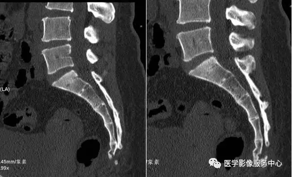 附病例(x线 ct) 来源网络 病人女性,外伤后骶尾部疼痛,dr