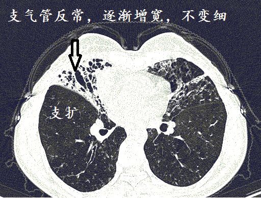 经典图谱,详细解说支气管扩张ct小诀窍!学不会我拜你为师