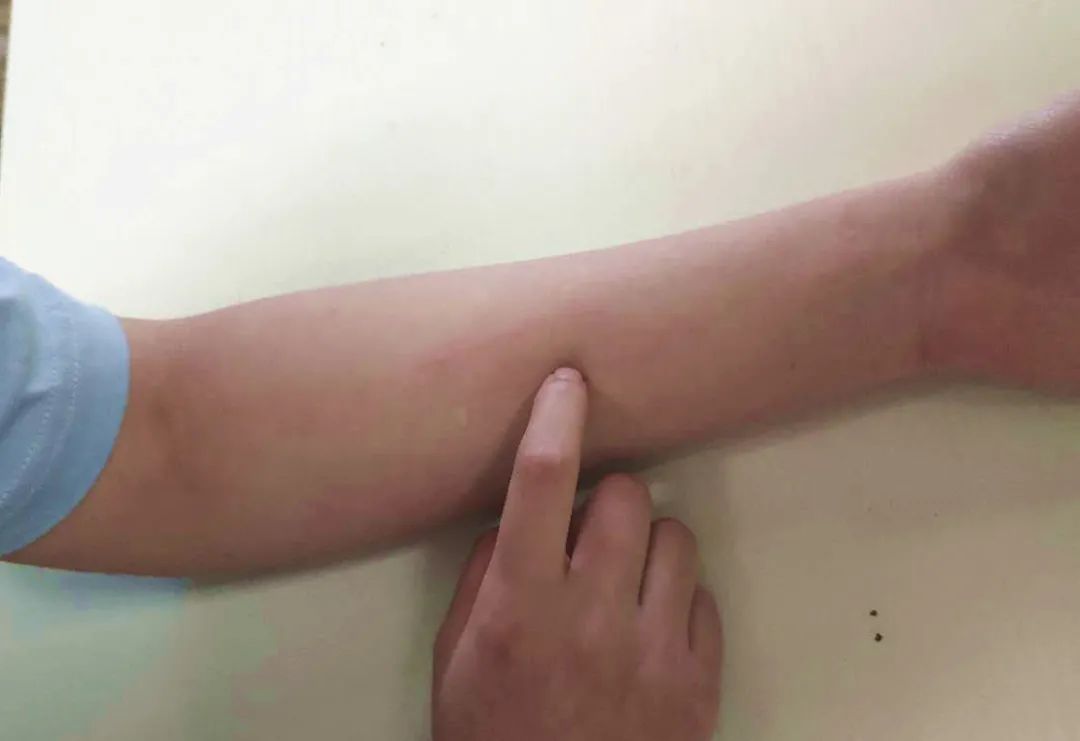 人工荨麻疹和一般性荨麻疹病因类似,属于过敏性疾病,过敏的病因主要