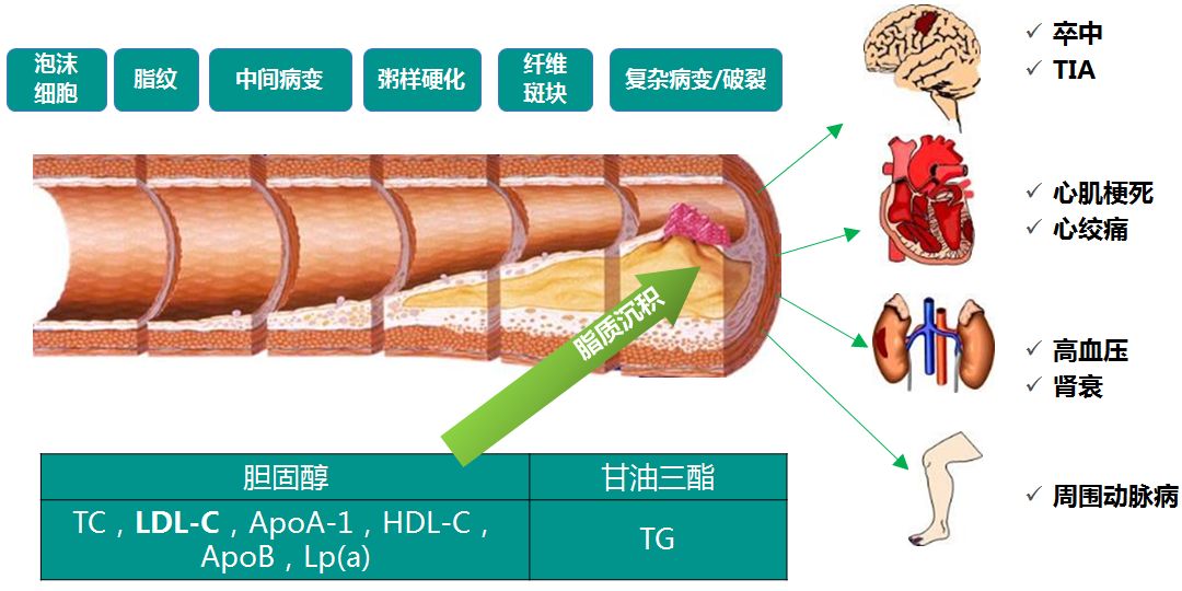 微课堂丨陈桢玥:中国血脂异常患者的调脂策略(上)