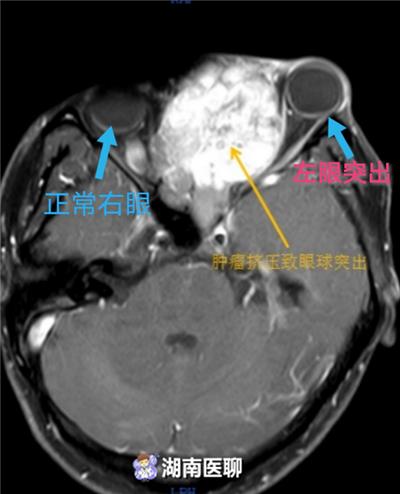 3个月前,他照镜子时突然发现自己左侧鼻面部隆起,左眼球凸起,还伴有