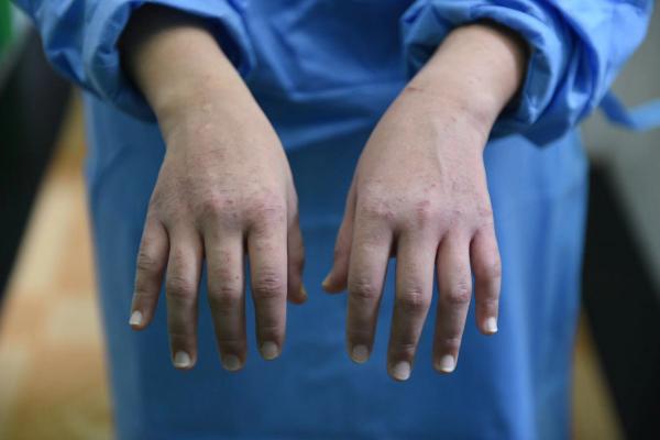 心疼湖南95后护士的手血痕累累专家介绍科学的手部皮肤护理