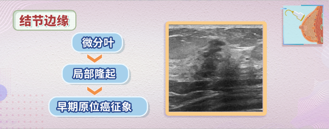 综上所述,如果一个乳腺结节的边缘